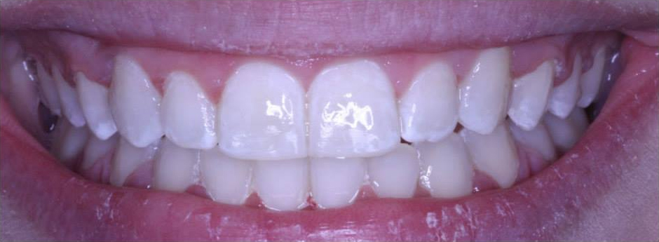 Close-up of person's teeth after cosmetic dentistry. The teeth are white and straight, and the gums are pink and healthy.