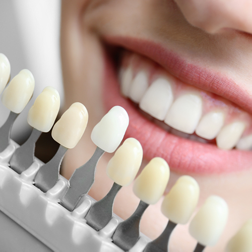 a person smiling, showcasing their white teeth. In the foreground, a shade guide with various tooth colors is held up against the teeth, used to compare and match the shade for dental treatments like veneers or whitening. 