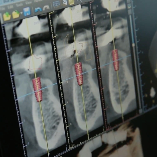  A close-up image of a computer screen displaying dental X-ray images. The X-rays show a detailed view of dental implants within the jawbone, with lines and measurements marked on the screen.