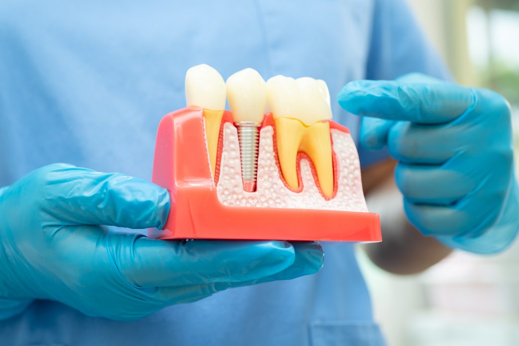 Dental implant, artificial tooth roots into jaw, root canal of dental treatment, gum disease, teeth model for dentist studying about dentistry.